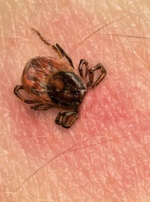 tick-bite-royalty-free-image-1618415252 tick-bite-royalty-free-image-1618415252